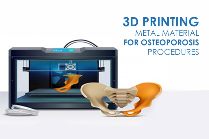 3D Printing Metal Material for Osteoporosis Procedures
